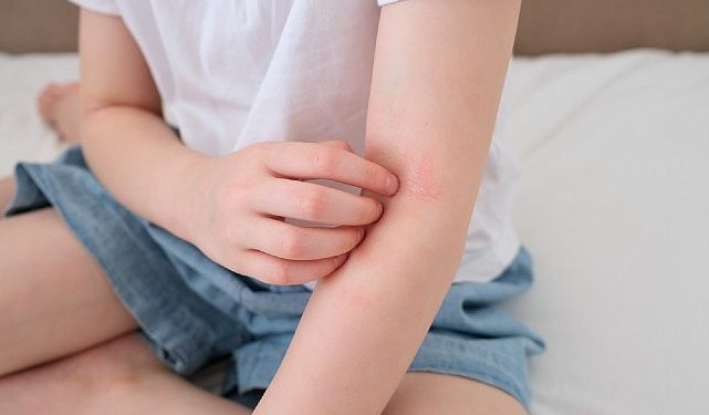 Çocuklarda ‘Alerjik Hastalıklar’ Hakkında Gerçek Sanılan 8 Yanlışlı Bilgi!