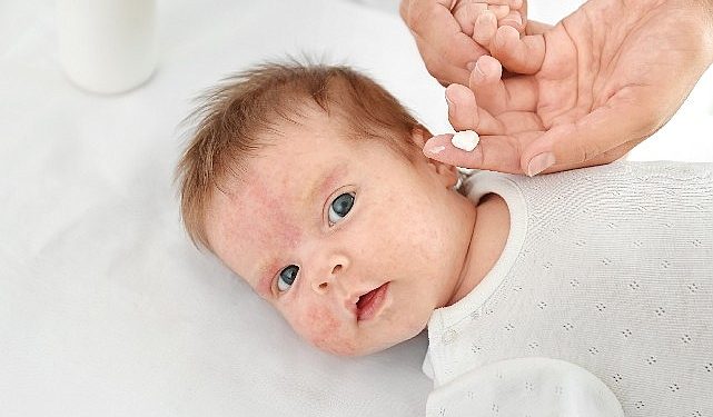 Yenidoğan Devrindeki İşitme Kaybı Konjenital CMV Enfeksiyonuna İşaret edebilir!