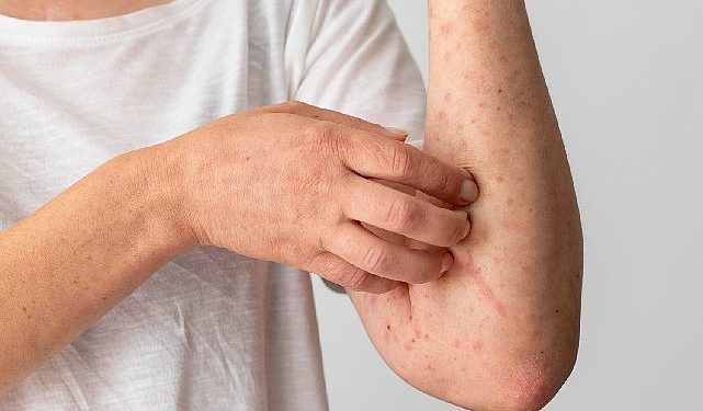 1 Ekim Dünya Ürtiker Günü: Gereksiz Besin Diyetleri Ürtikeri Tetikliyor