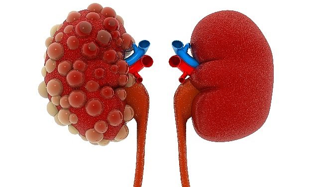 Abdi İbrahim Otsuka Medikal Yöneticiliği: Polistik Böbrek Hastalığının Seyrini Değiştirmek Mümkün