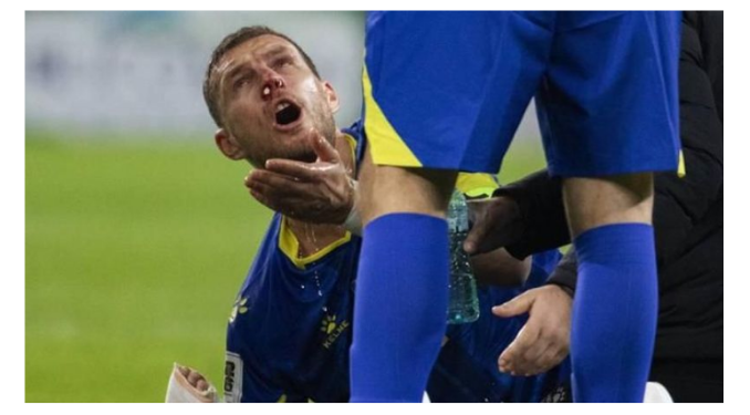 Edin Dzeko’nun, Romanya maçında burnu kırıldı